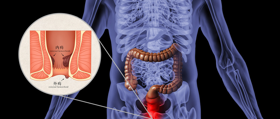 柳州东大肛肠医院：痔疮手术疼不疼？什么情况下需要手术？