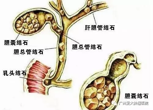 胆结石位置图图片