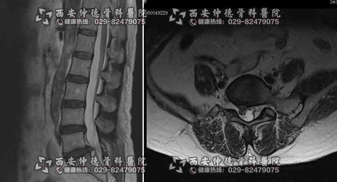 西安仲德脊柱微创外科UBE技术微创解决腰椎间盘“突出”问题