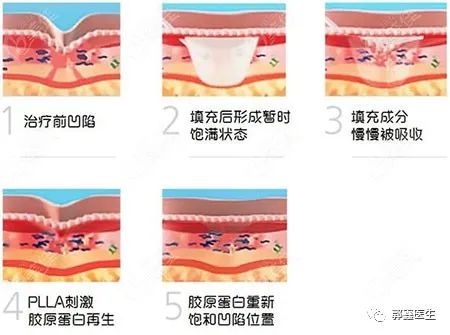 郭鑫医生口碑好吗？不明注射物取出困难吗？