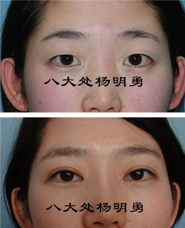 重睑术前及术后3月.png