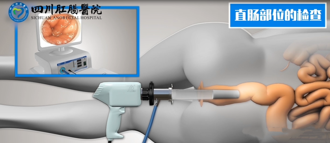 1765173554781713.png 电子肛门镜检查.png