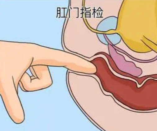 1765173697288354.png 肛门指检.png