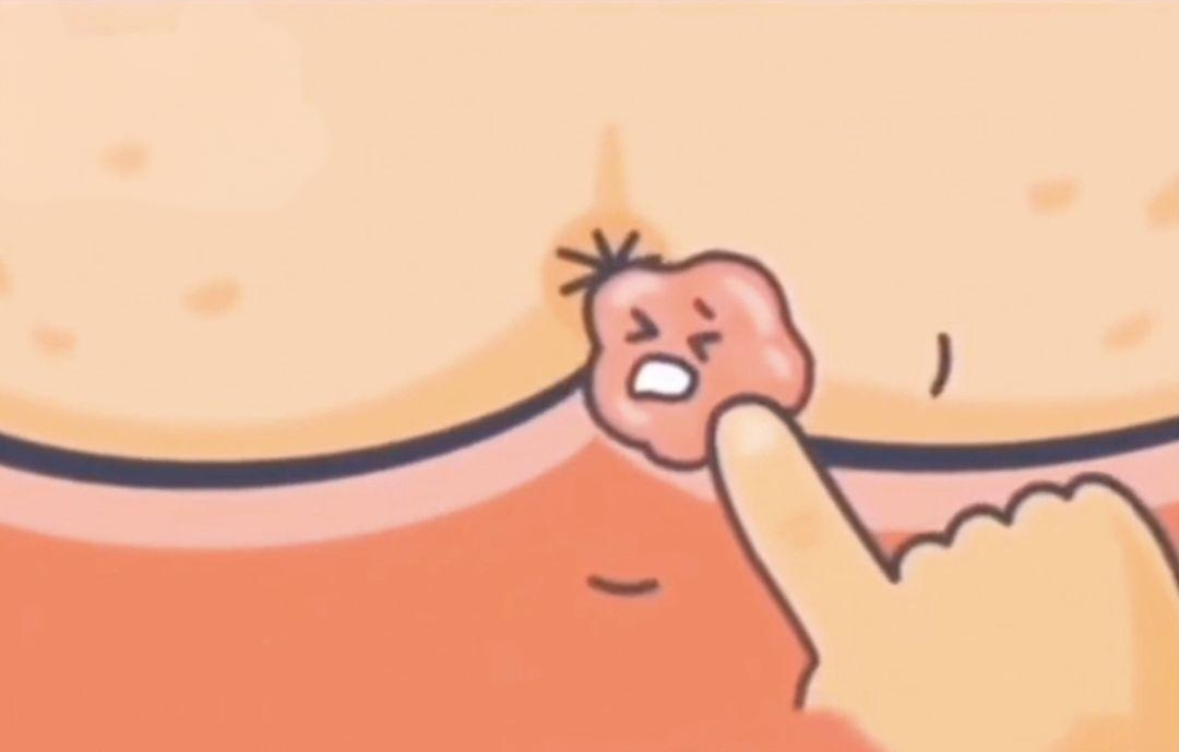 痔疮肉球凸出.png