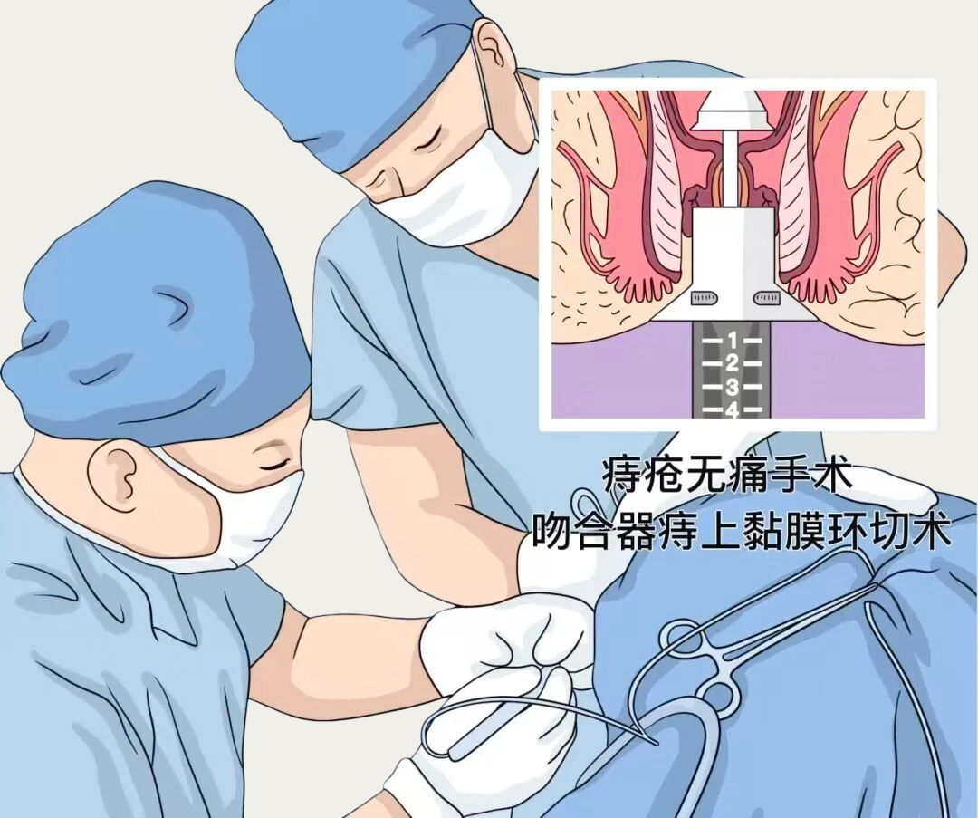 痔疮手术22222640_副本.png