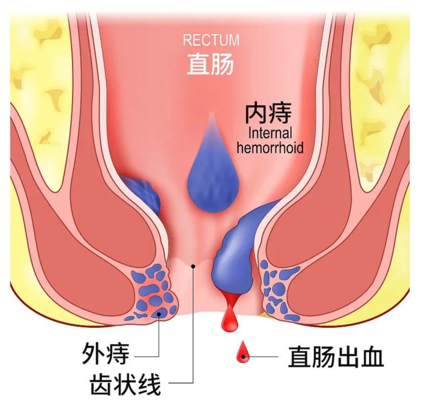 痔疮出血423640.png