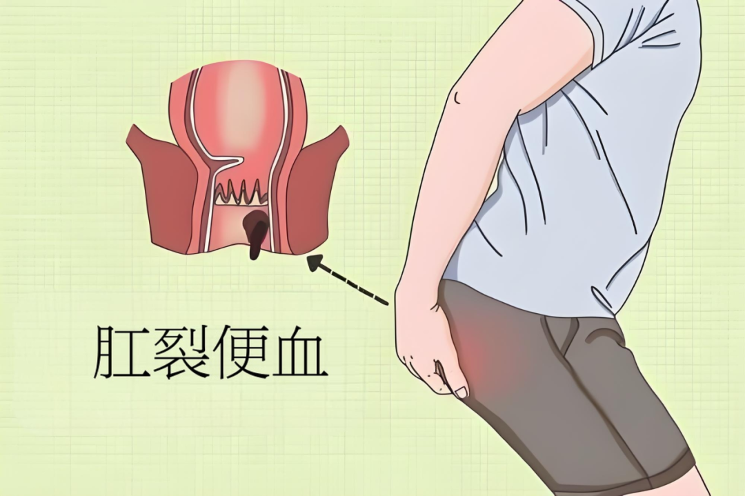 末伏秋燥，天津欧亚肛肠医院告诉您如何预防肛裂